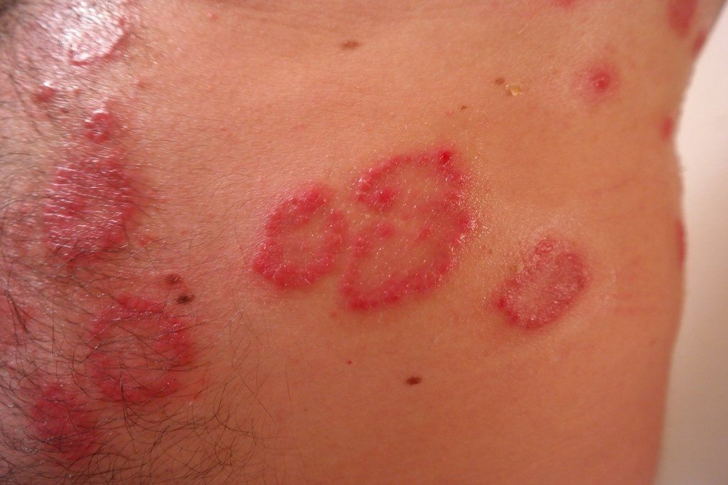 atopic dermatitis inflamed rash